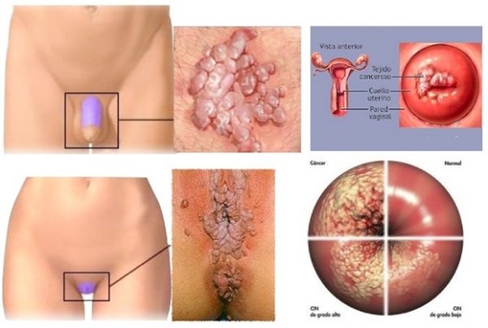 Virus papiloma humano detecta del el como se